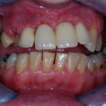 Close up of teeth before dental implant treatment