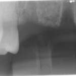 Radiograph showing bone before implant placement.