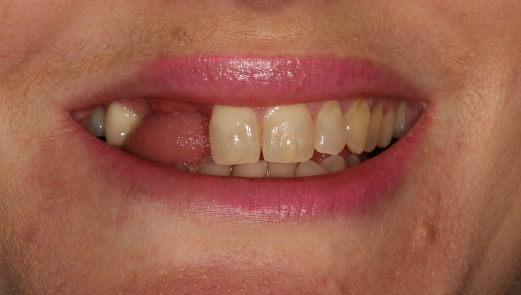 missing teeth before implant treatment