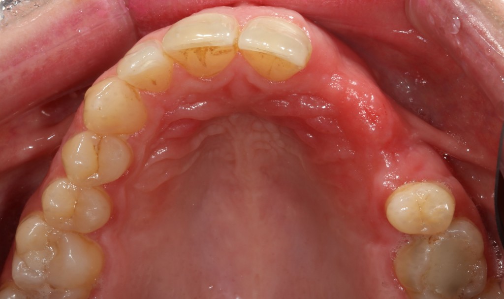 Occlusal view showing redness from partial denture