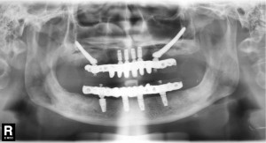 Final panoramic radiograph showing definitive bridges in place