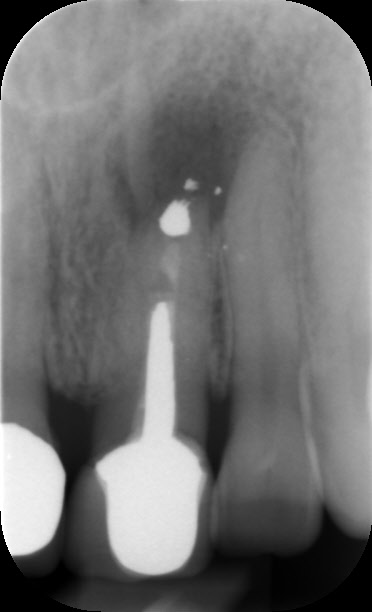 Root canal treated tooth showing apicectomy and infection around root.