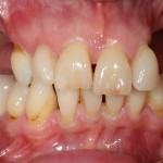 brighton implant clinic new smile5