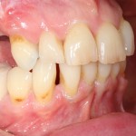 brighton implant clinic new smile6