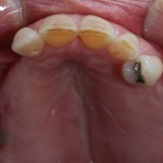 brighton implant clinic new smile9