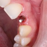 Neodent universal post on implant