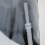 Implant surgery radiograph