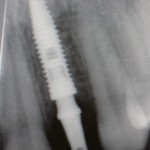 Neodent universal post abutment attached to implant