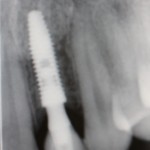 Final radiograph showing implant, abutment and crown