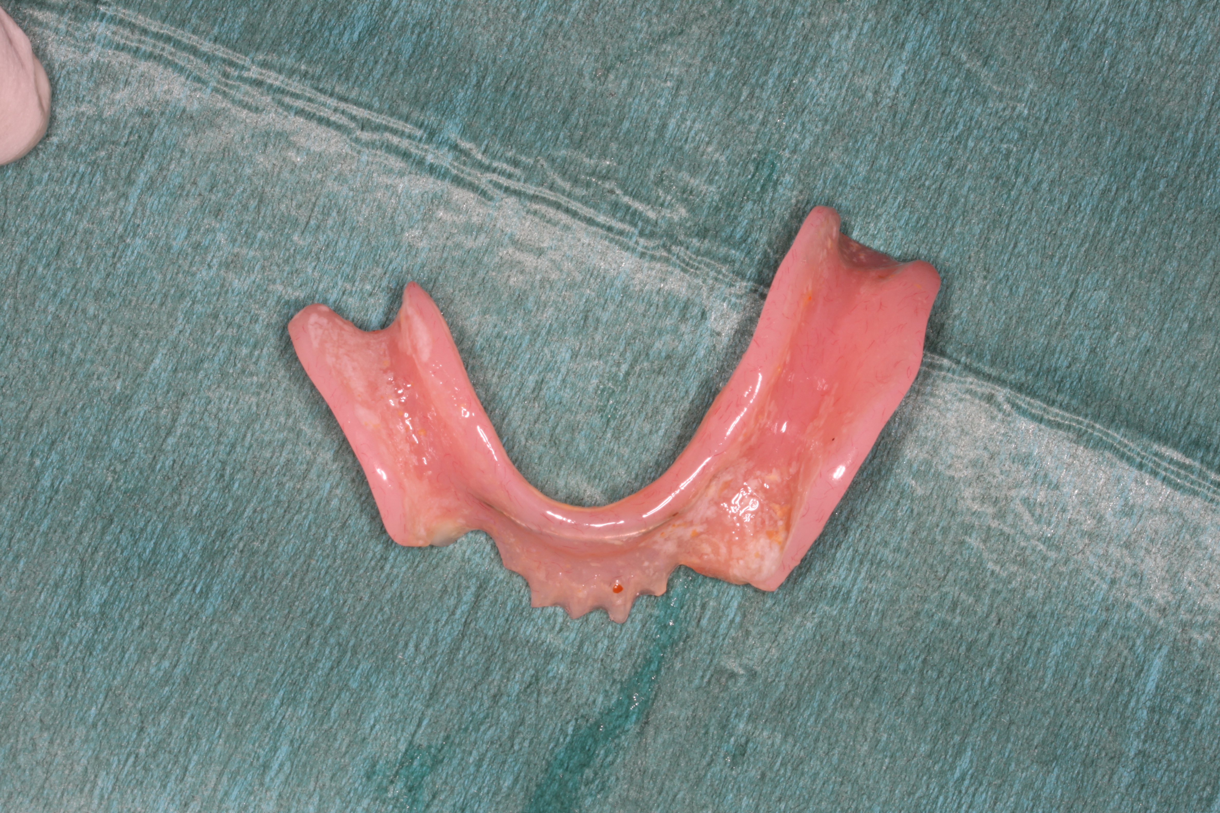 Lower denture showing fitting surface with plaque present