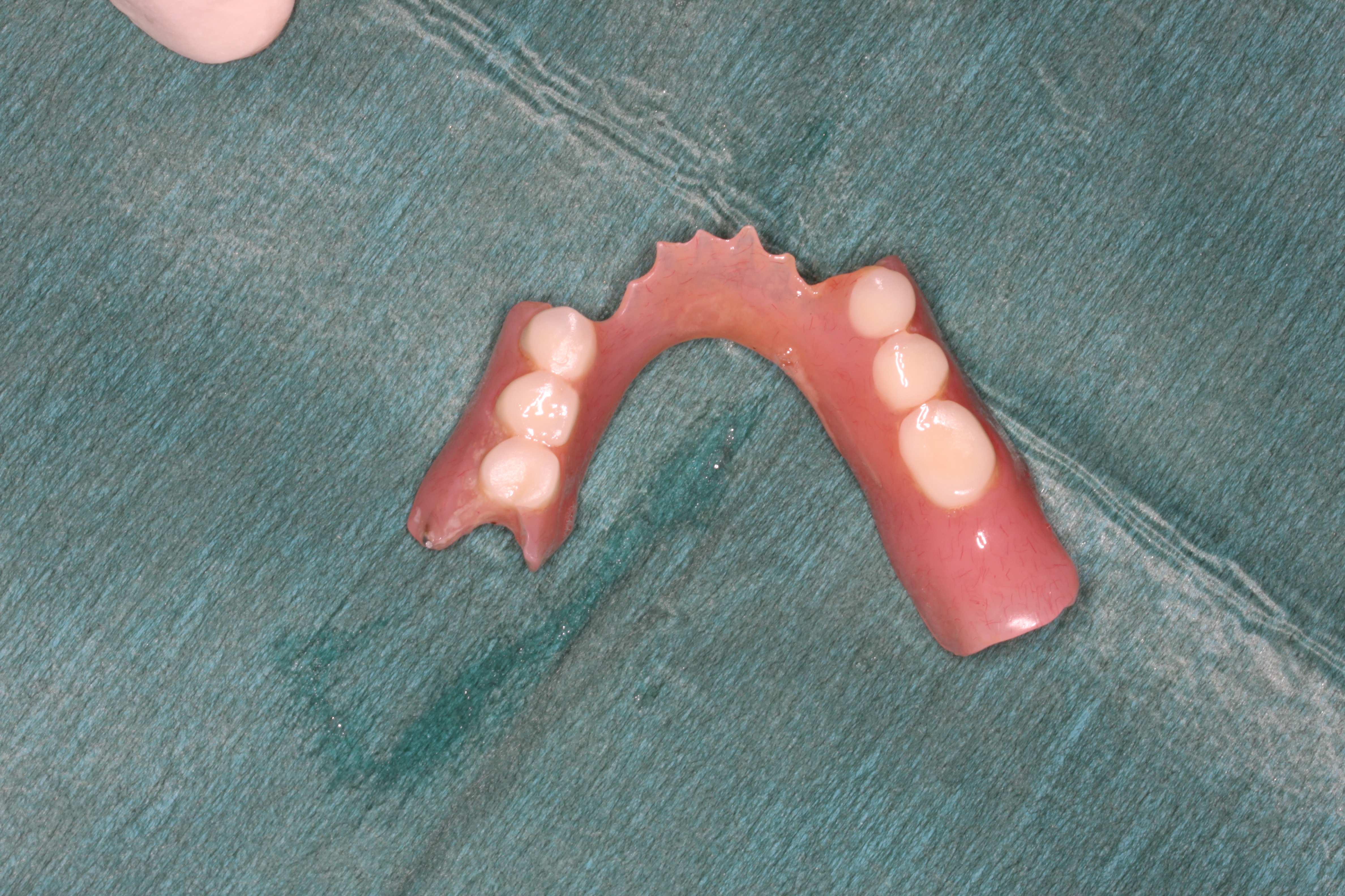 Lower partial denture