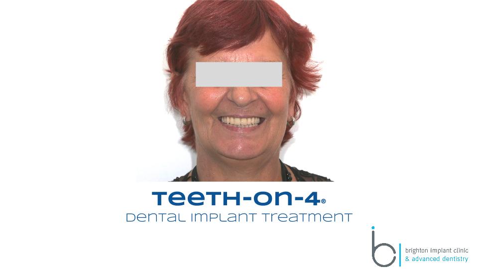 A new smile with dental implants