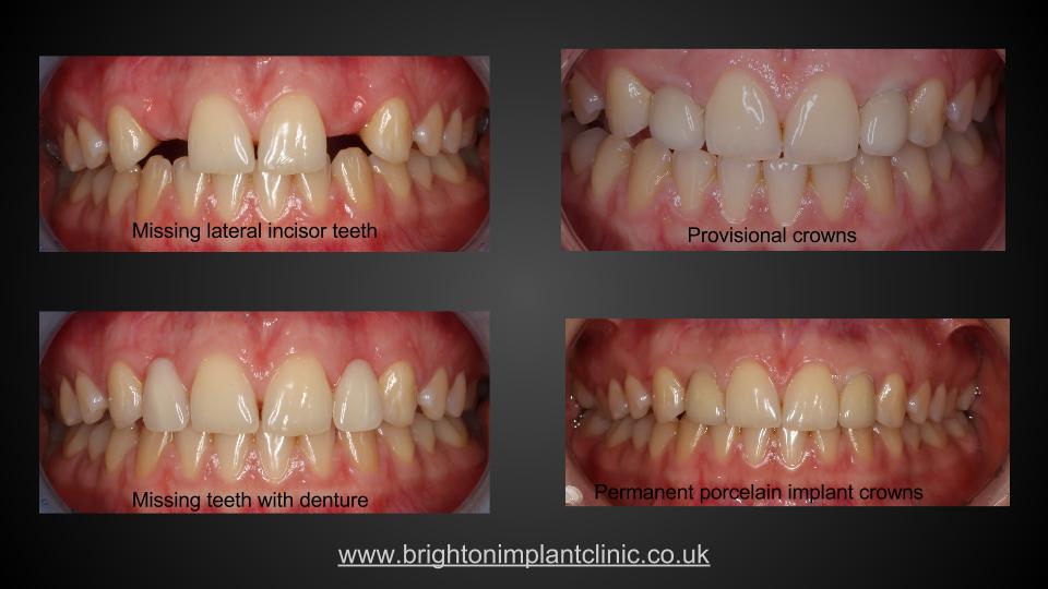 Before and after implant treatment