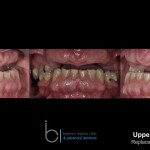 Missing teeth - Brighton Implant Clinic phase3
