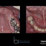 Missing teeth - Brighton Implant Clinic phase4