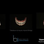 Missing teeth - Brighton Implant Clinic phase5