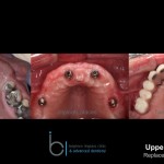 Missing teeth - Brighton Implant Clinic phase6