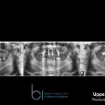 Missing teeth - Brighton Implant Clinic phase8