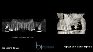 Single tooth dental implant 3 brighton implant clinic