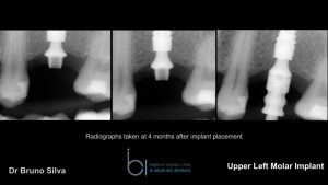 Single tooth dental implant 6 brighton implant clinic