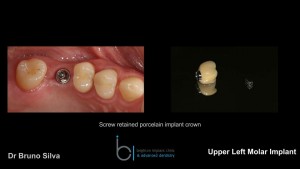 Single tooth dental implant 8 brighton implant clinic