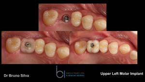 Single tooth dental implant 9 brighton implant clinic