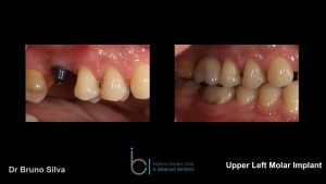 Single tooth dental implant 10 brighton implant clinic