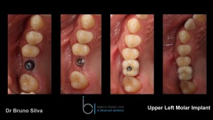Single tooth dental implant 12 brighton implant clinic