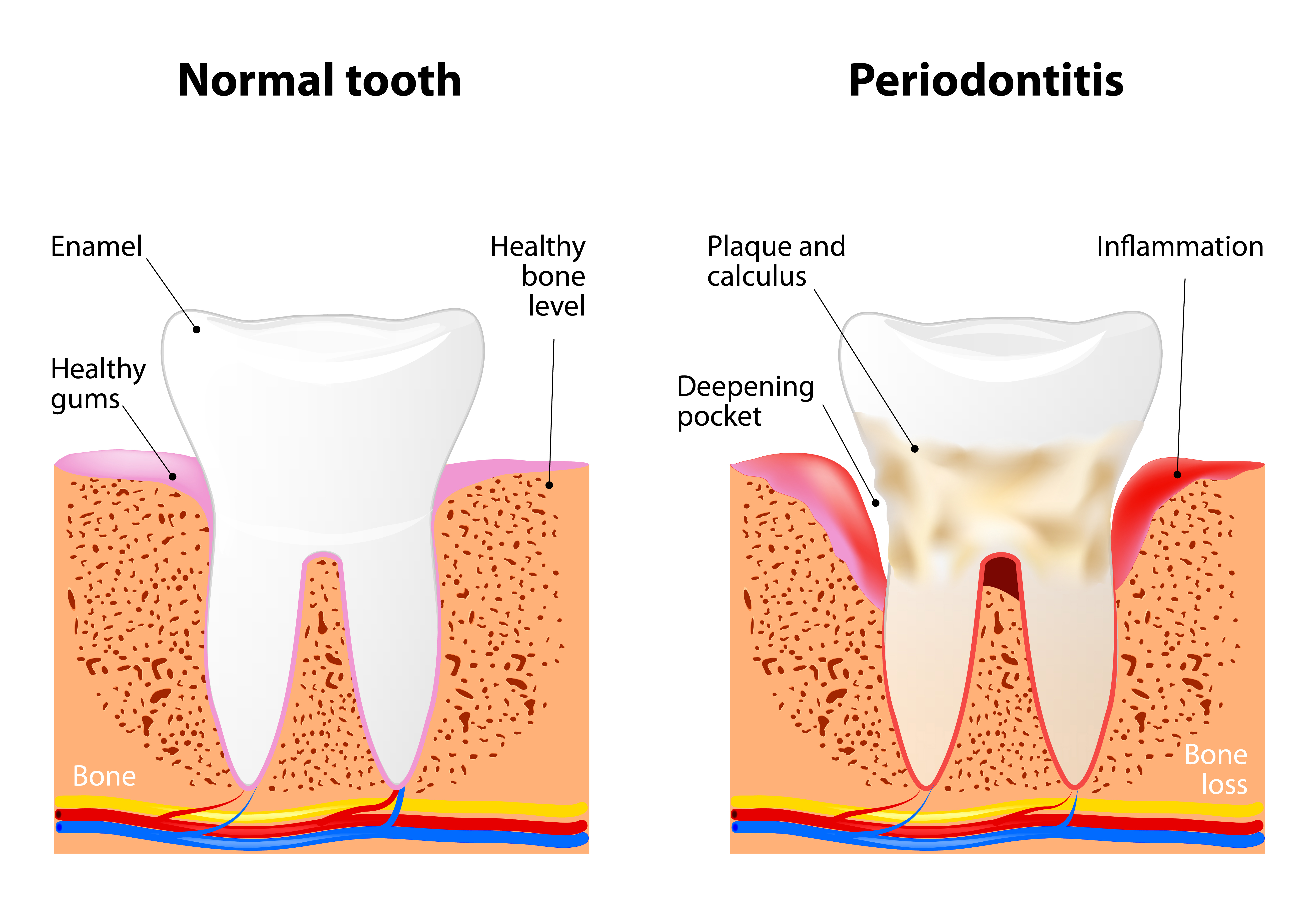 Periodontitis is a inflammatory diseases affecting the periodontium, the tissues that surround and support the teeth