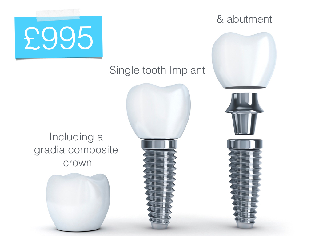 cheap dental implants