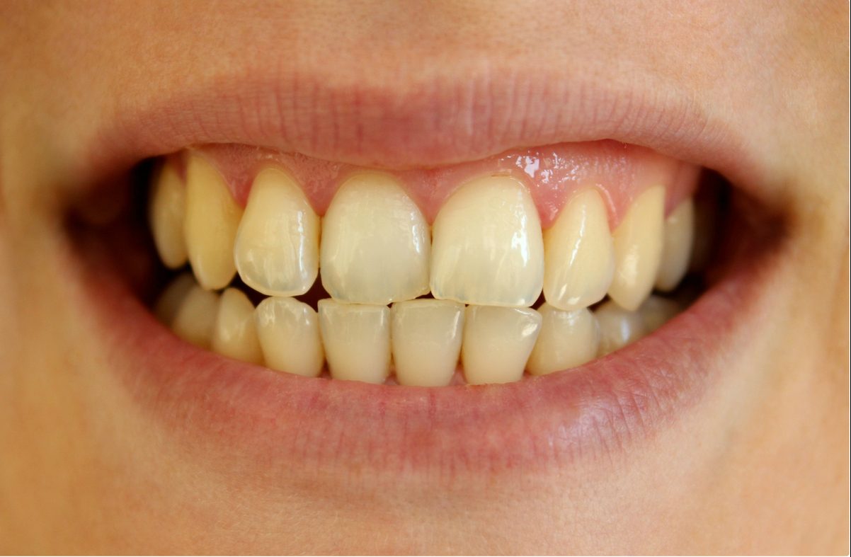 Why Are My Teeth Yellow? : Dental Implants