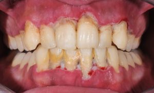 gum disease 