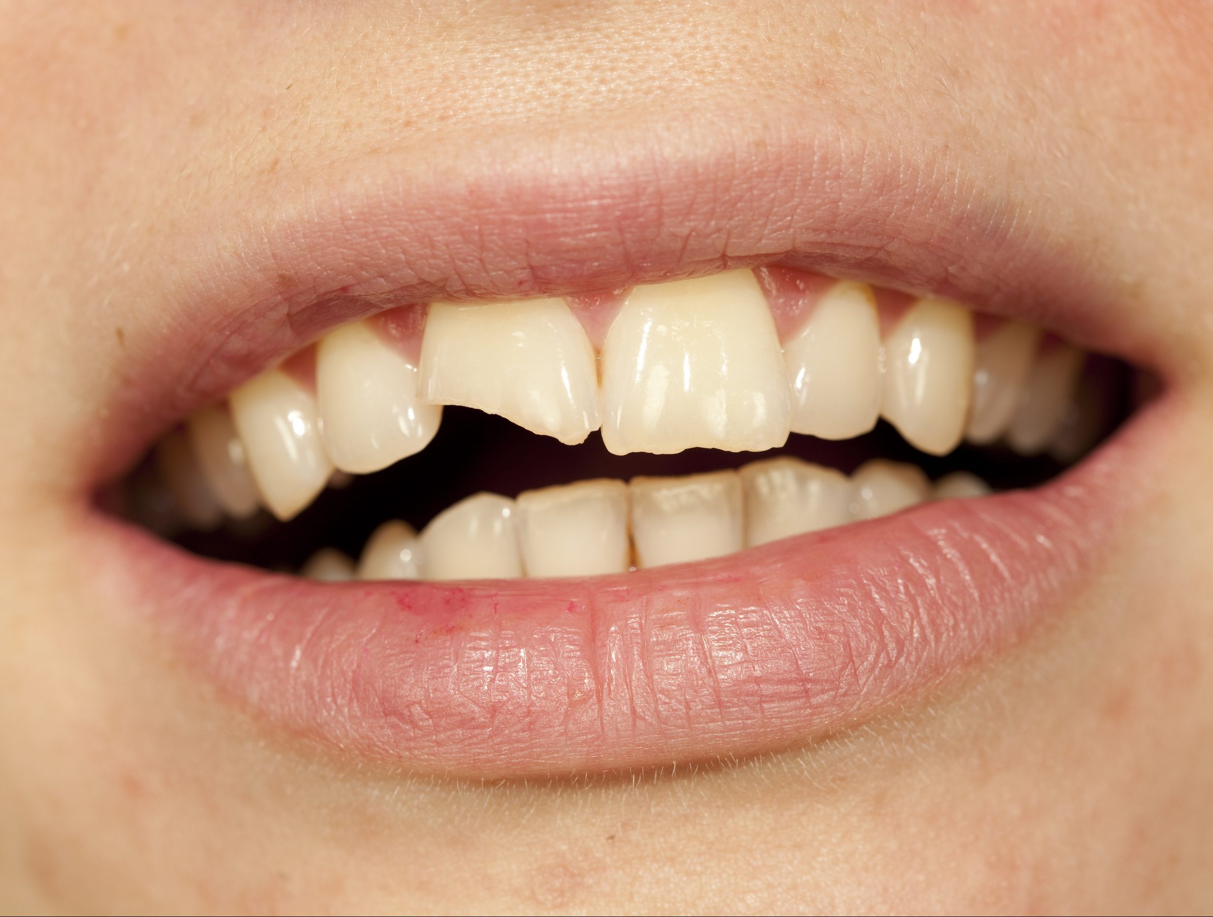 Oral Piercings And Oral Health What You Should Know Dental Implants 