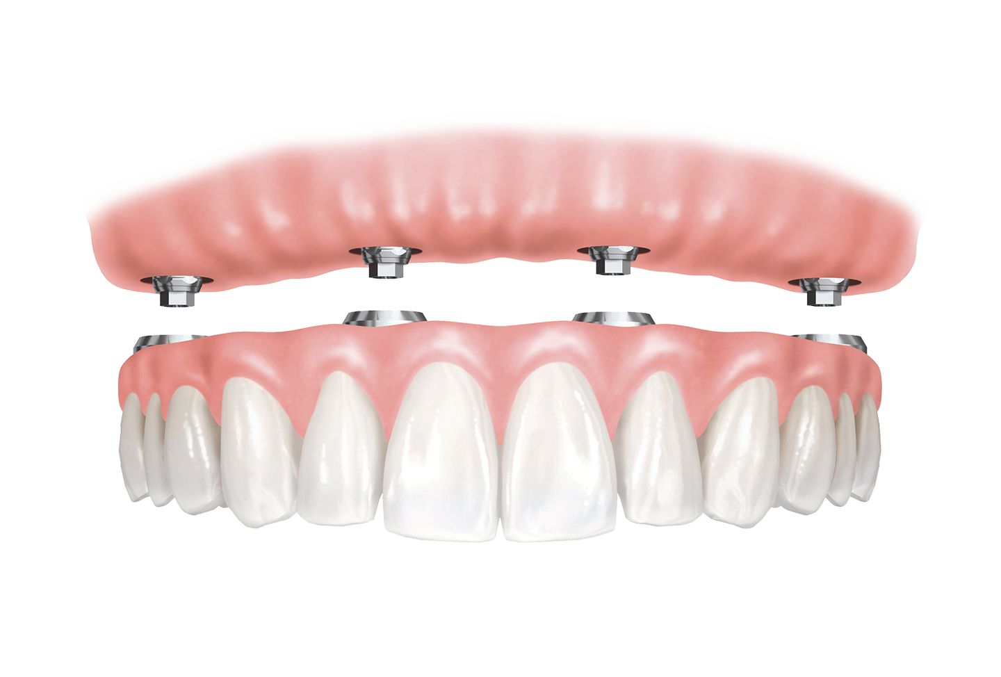 dentures-implants-fixed-2@0,75x