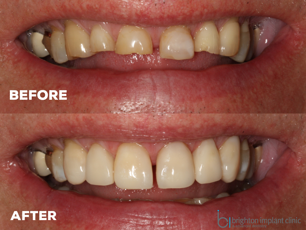before and after tooth wear