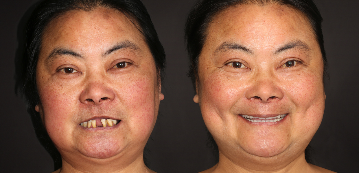 Before and After zygomatic dental implants
