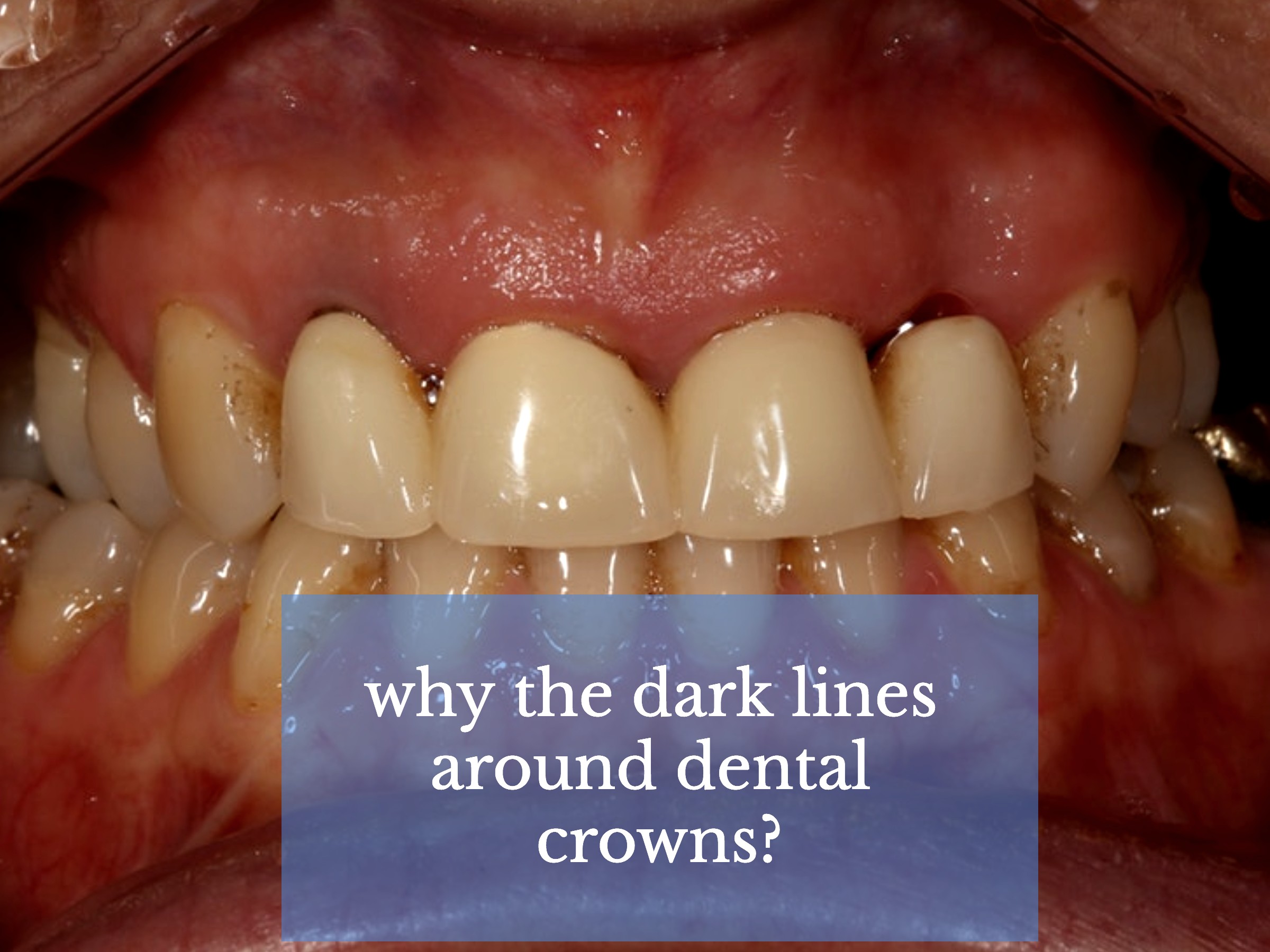 dark lines around dental crowns