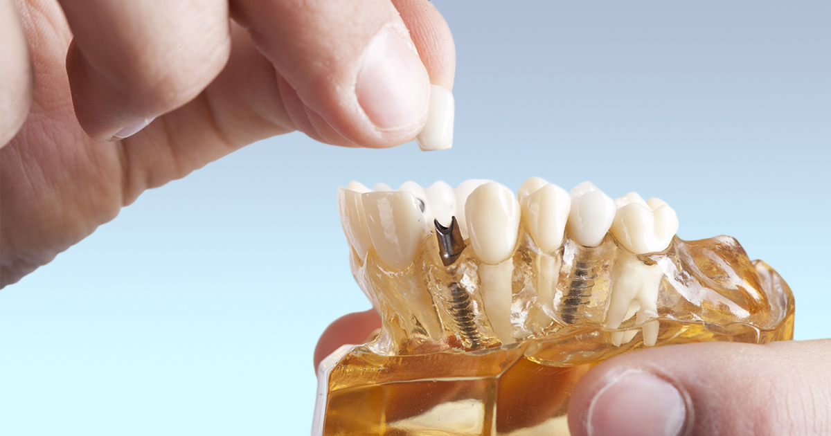 dental implant courses europe