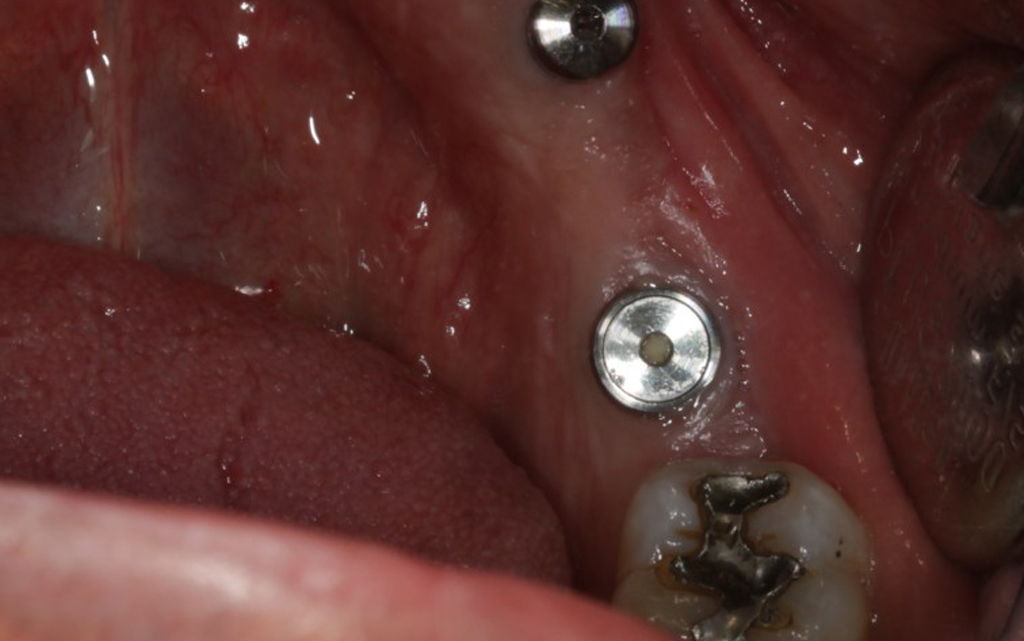 healing abutments in place after 4 months of healing
